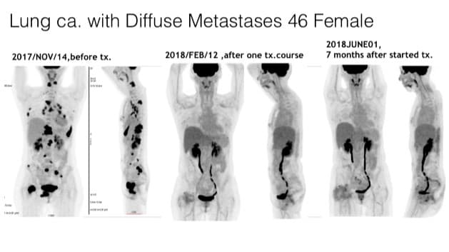 從阿華診斷出得了多發性轉移肺癌末期，2017/11/14-2018/6/1追蹤治療的正子攝影PET-CT影像演變過程。圖 / 楊友華提供