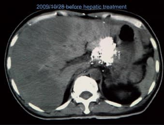 2009．10．28治療前肝臟斷層掃描結果。圖 / 楊友華醫師提供