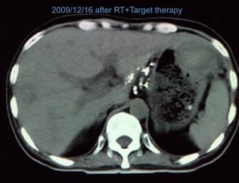 2009.12.16-RT標靶治療後肝臟斷層掃描追蹤。圖/楊友華醫師提供
