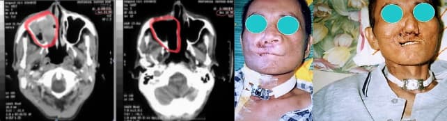 動脈灌注化學治療前後，家電行林老闆打垮極度抗藥性癌腫瘤的斷層掃描對照比較(圖左)與實境拍攝前後對照比較圖。 圖 / 楊友華